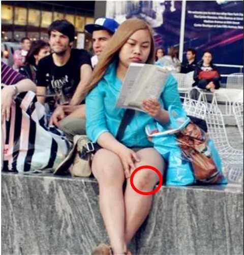 女友膝盖上的淤青，这是被绿了吗？第3张