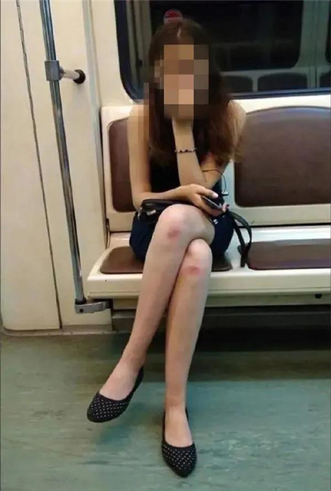 女友膝盖上的淤青，这是被绿了吗？第12张